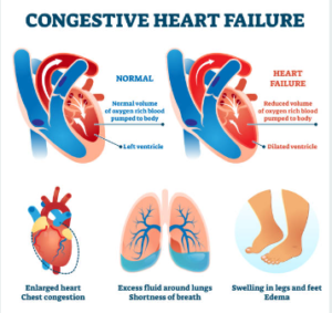 Illustration of congestive heart failure showing a comparison between a normal heart and a heart affected by heart failure, with diagrams of enlarged heart, excess fluid in lungs, and swelling in legs.